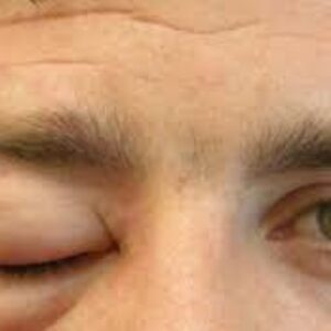 آنژیوادم: علائم، علل و روش‌های درمان