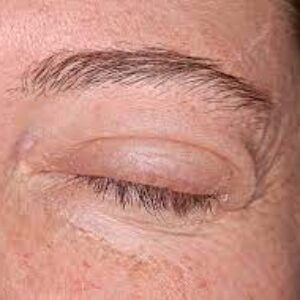 آشنایی با آنژیوادم: تورم ناگهانی صورت و بدن