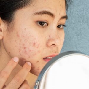 درمان‌های طبیعی آکنه بارداری