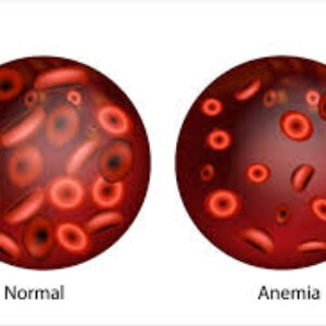 کم‌خونی فانکونی؛ یک اختلال ژنتیکی نادر